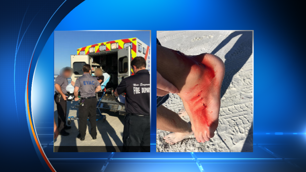 Teen shares experience of getting bitten by shark