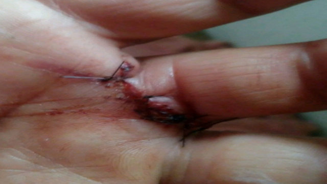 Linda Warren's injured hand