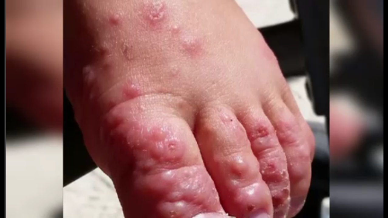 How Long Can Hand Foot And Mouth Sores Last