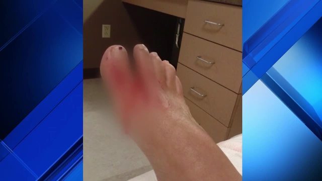 Woman Surfing In St Augustine Beach Bitten By Shark